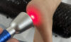 High-Intensity Laser Therapy: An Effective Treatment Option