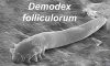 Demodex Mites: Link to Chronic Dry Eye Symptoms