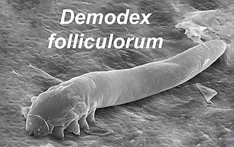 Demodex Mites: Link to Chronic Dry Eye Symptoms